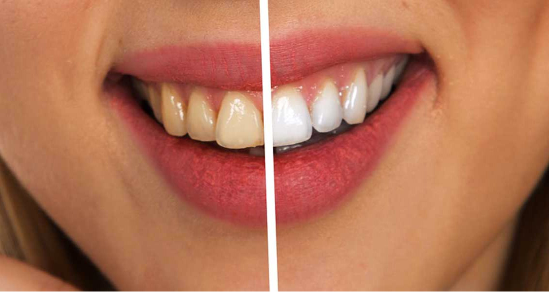 INTERLABS productos salud oral: SOLUCIÓN BUCAL VÁLVULA SPRAY ANTIPLAC-B® Digluconato de Clorhexidina al 0.2%, Profilaxis SENSIBLANQ Pulido Dental (Perlita), Desensibilizante Dentinal (Arginina) y Blanqueador Manchas Exógenas (Hexametafosfato de Sodio), ResinBilliant GEL DENTAL TRASLÚCIDO Abrillantar y Pulir Resinas Dentales.Faringoamigdalitis, Gingivoestomatitis Herpética, Gingivitis, Periodontitis, Caries (remineralización) y demás enfermedades producidas por la Placa Bacteriana, Profilaxis dental, Desensibilizante Dentinal, Desensibilización después de Tallar un Diente, Desadaptación de los Provisionales ó Temporales, Pre y post Blanqueamiento Dental, Hipersensibilidad post Talla Dental en Caries y Muñones, Post Detartraje y Alisado Radicular.